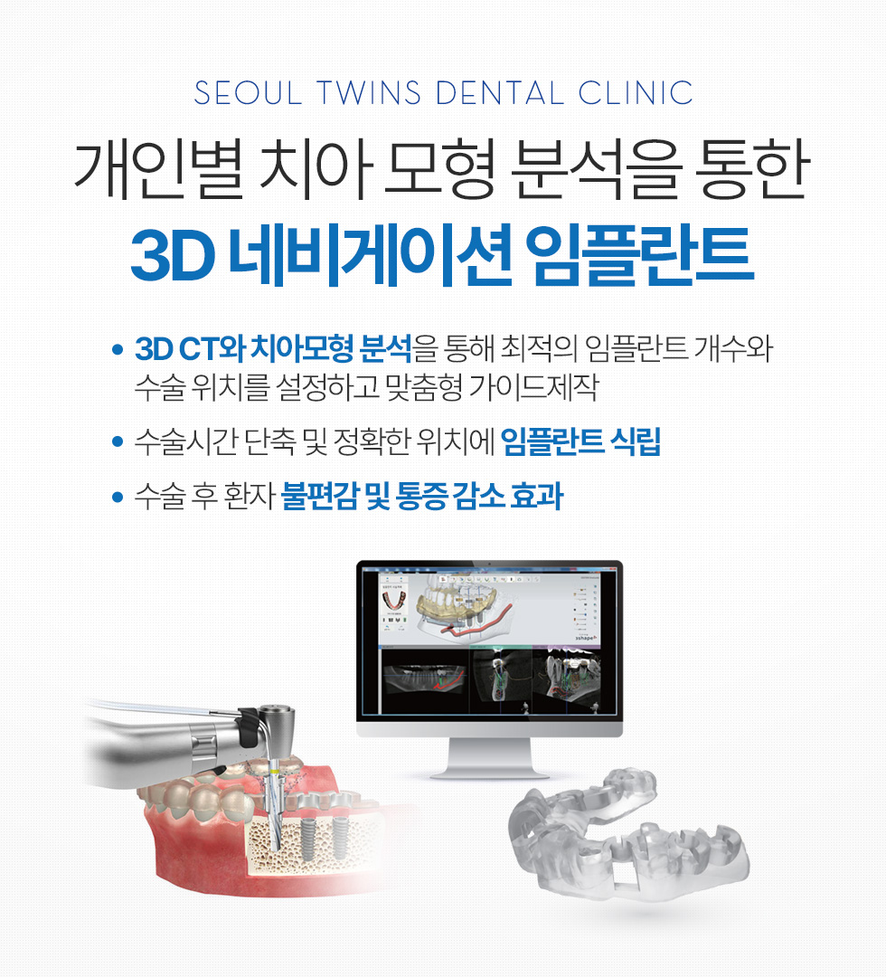 개인별 치아 모형 분석을 통한 3D 네비게이션 임플란트