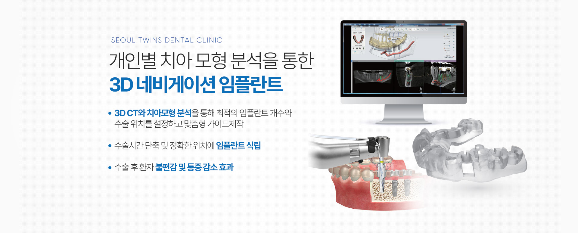 개인별 치아 모형 분석을 통한 3D 네비게이션 임플란트